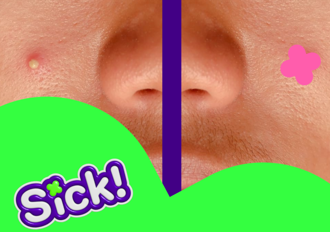 avant après patch bouton